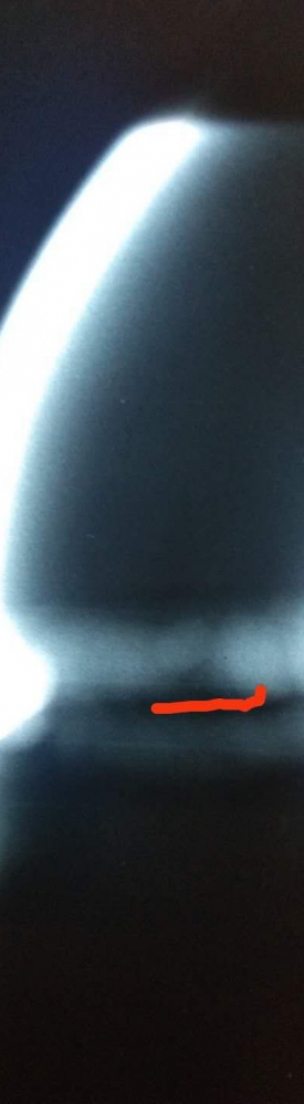 小徑管坡口未熔合