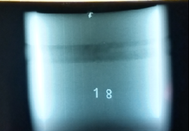 請教   這種底片的結論應怎樣？